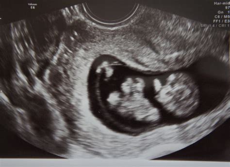 11 Week Ultrasound Boy Or Girl