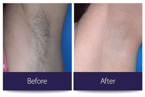 Laser Hair Removal Algonquin Il And Crystal Lake Il Favia Primary