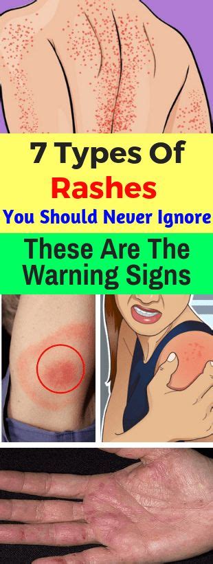 10 Types Of Rashes You Should Know In 2021 Types Of Rashes Different