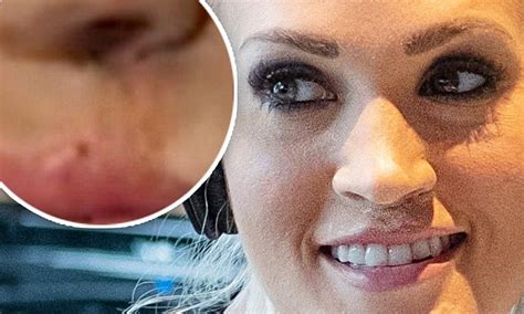 Carrie Underwood Reveals Scar On Lip As She Worries Disfigurement Would Scare Three Year Old