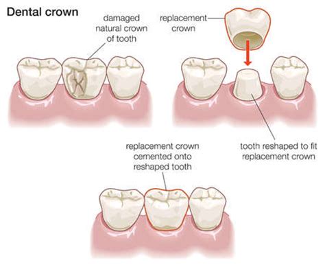 The good news is that even without insurance, there are ways to get affordable dental care for your family. How Much Does a Crown Cost? | New Health Advisor