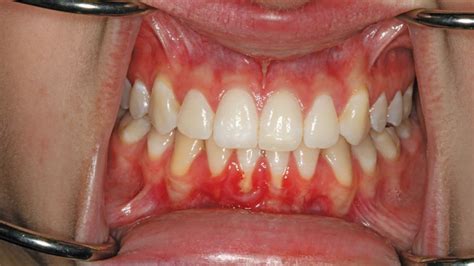 A Closer Look At Gingival Recession Dimensions Of Dental Hygiene