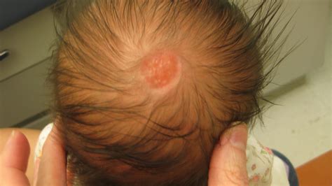 Common Birthmarks The Clinical Advisor