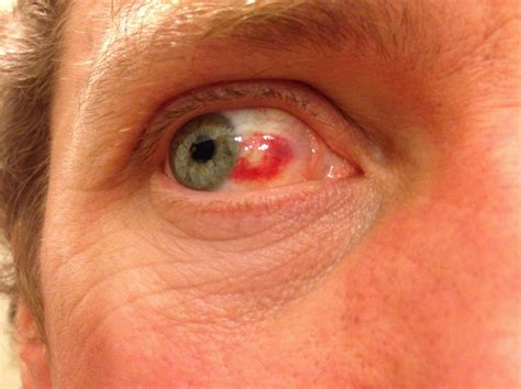 Sub Conjunctival Haemorrhage Clearing Dont Be A Salmon