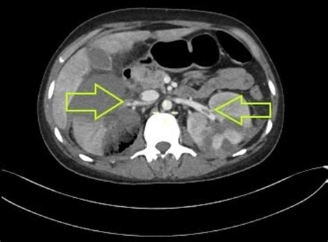 Cureus A Rare Case Of Paroxysmal Nocturnal Hemoglobinuria With