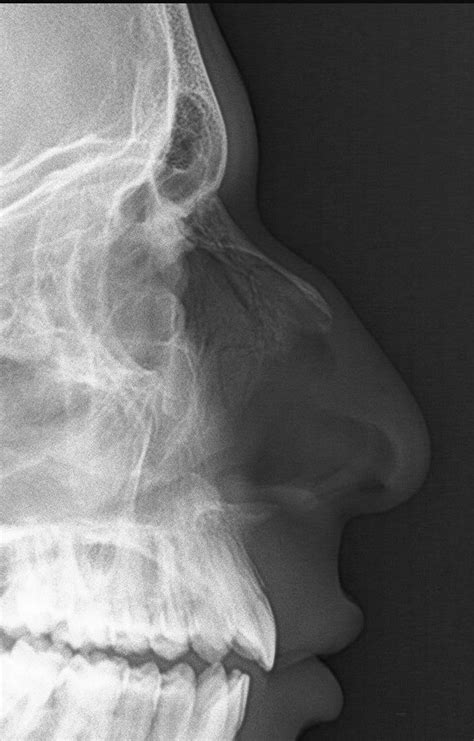 Nasal Bone X Ray Anatomy
