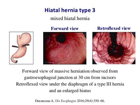 Diagnosis Of Sliding Hiatal Hernia
