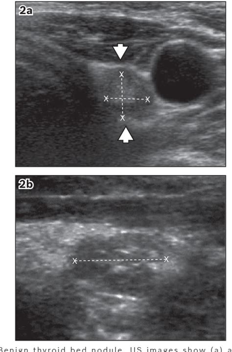 Figure 2 From Post Thyroidectomy Neck Ultrasonography In Patients With