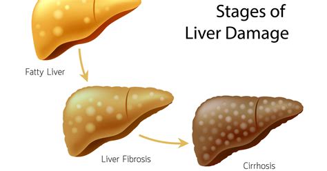 I Was Diagnosed With Fatty Liver Disease What Is It And Is This