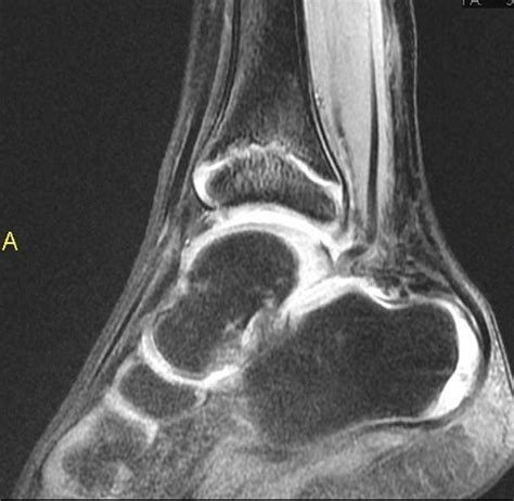 Ankle Fractures Pediatric Pediatrics Orthobullets