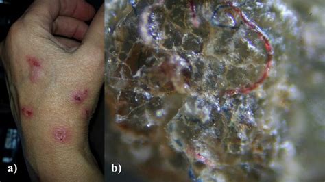 Morgellons Disease Patient A Skin Lesions On The Hand B Magnified