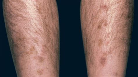 Black Spots On Legs Diabetes Diabetes Poster