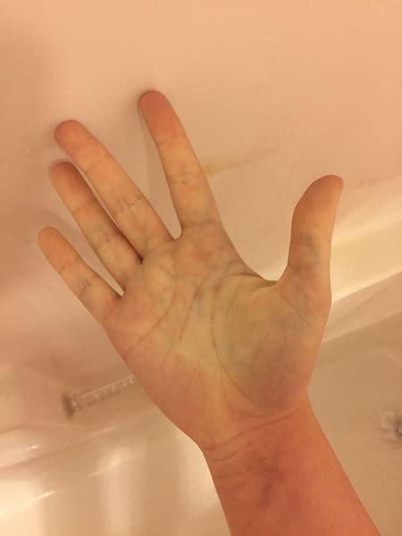 Blue Veins In Palms Sign Of Pregnancy Picture Attached Mumsnet
