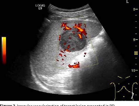 Figure 2 From Primary Spleen Lymphoma Visualized With Contrast Enhanced