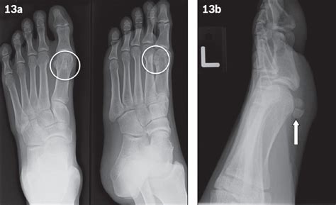 Common Accessory Ossicles Of The Foot Imaging Features Pitfalls And