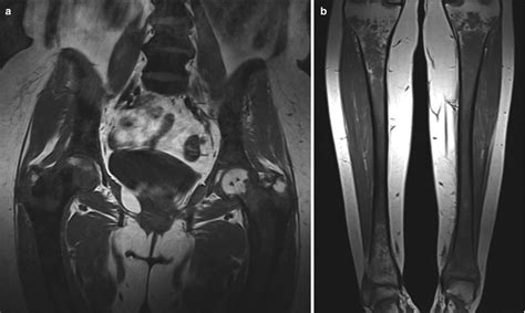 Mri Of The Abnormal Bone Marrow Diffuse Pattern Radiology Key