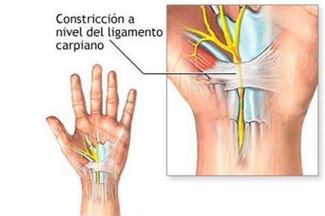 49 Síndrome Del Túnel Carpiano ¿qué Es Y Cómo Se Trata Fisiolution