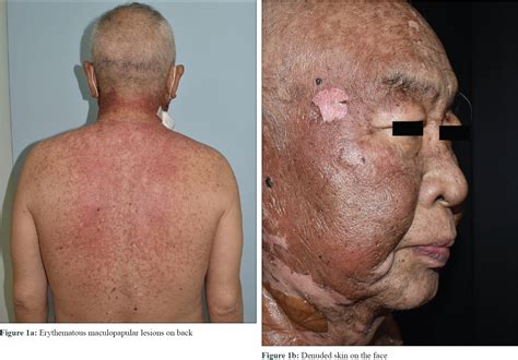 Stevensjohnson Syndrome Like Reaction Without Mucosal Lesions