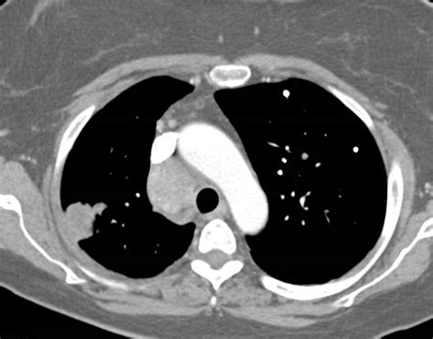 Metastatic Renal Cell Carcinoma To Lung Mediastinum And Spleen Chest