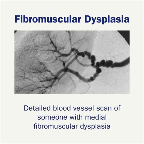 Fibromuscular Dysplasia The Foundation To Advance Vascular Cures