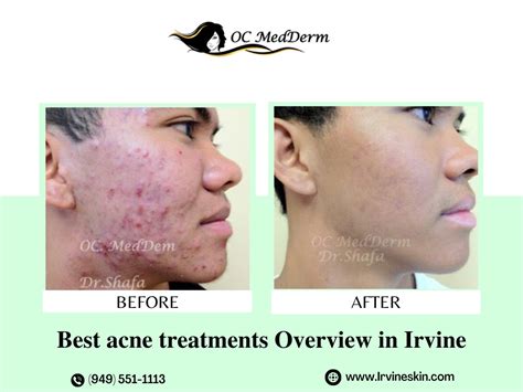 Acne Treatments In Irvine And Orange County Dr Omeed Ahadiat By Oc