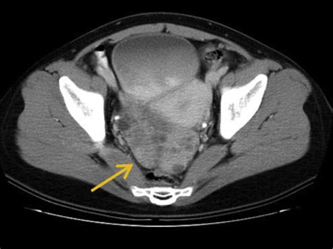 Ct Scan Revealed A Lobulated Mass In The Left Ovary Arrow With