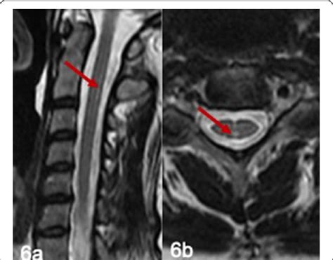 Spinal Mri In Patient 4 T2 Weighted Sagittal A And Axial View B