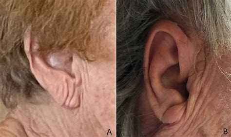 A Frank Discussion About Earlobe Creases
