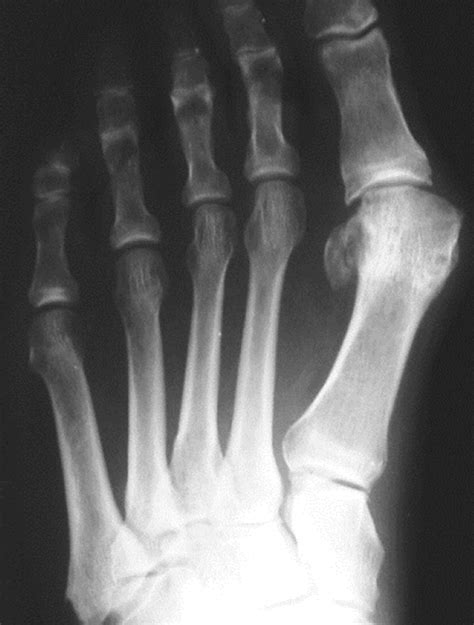 References In Fifth Metatarsal Osteotomies Clinics In Podiatric Medicine And Surgery
