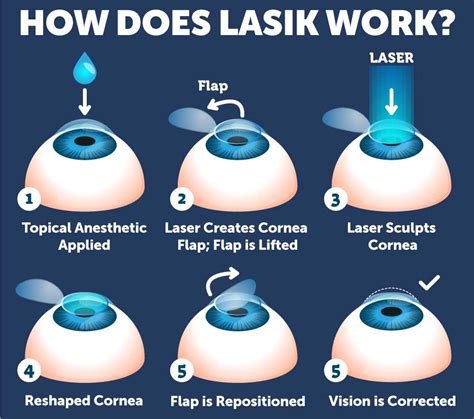 Lasik Surgery Recovery Process Wolfe Eye Clinic