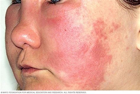 Causes Of Facial Hives Hot Nude Comments 2