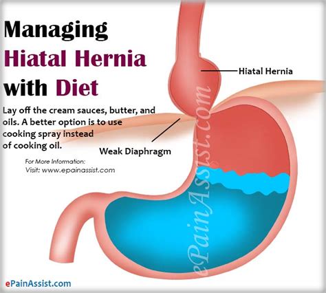 Epigastric hernias can appear during imaging tests for other medical conditions. Managing Hiatal Hernia With Diet, Lifestyle Changes, Treatment