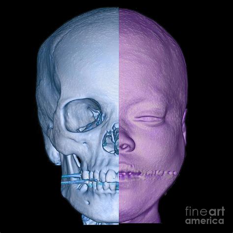 Human Face And Skull Enhanced 3d Ct Scan Photograph By Living Art