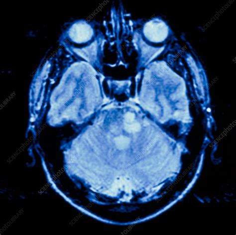 Mri Scan Of A Brain With Multiple Sclerosis Stock Image M2100074