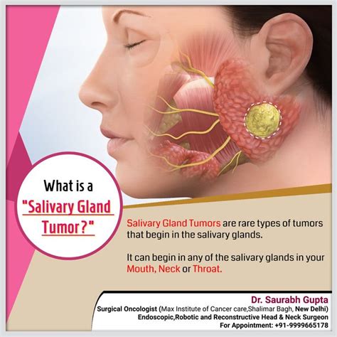 Pin On Salivary Gland Tumor