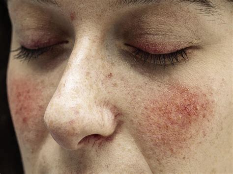 Czerwone plamy na twarzy przyczyny przebarwień i jak je leczyć Choroby Polki pl