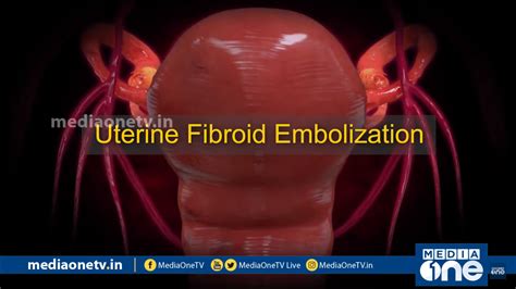 Uterine Fibroid Embolization Stethoscope