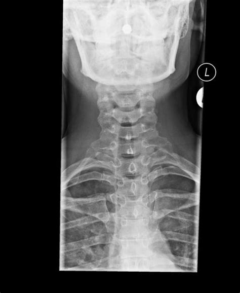 Bilateral Cervical Ribs Radiology Case Novelty