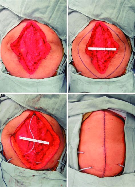 Case Example Ventral Hernia Repair With Inlay Bioprosthetic Mesh And