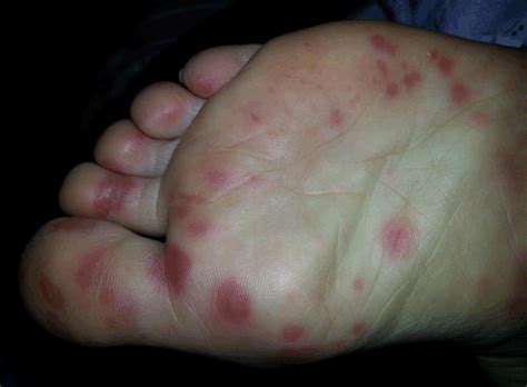 Foot And Mouth Disease Australia Cost