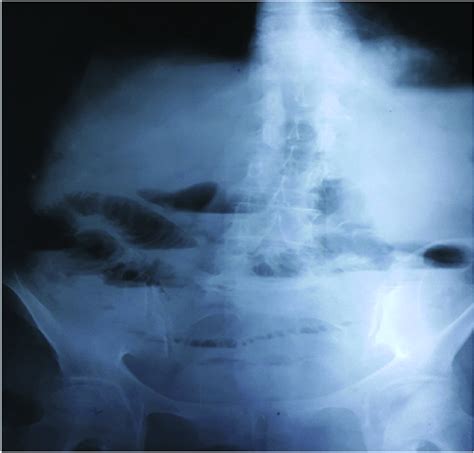 Plain Abdominal X Ray Showing Increased Air Fluid Levels Without Air In