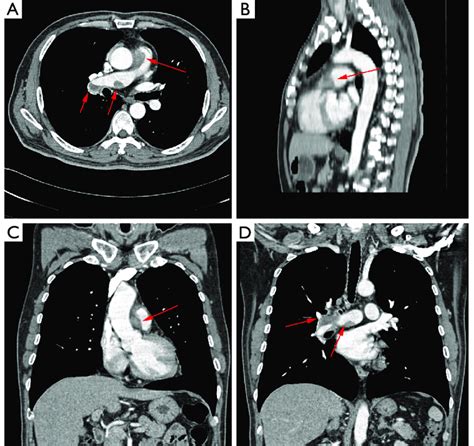 Contrast Enhanced Ct Scans Showed Filling Detects In Main Pulmonary