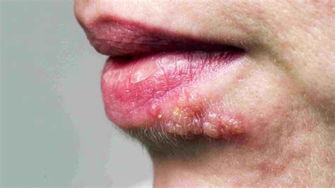 Pimples On The Tongue How To Get Rid Of Them
