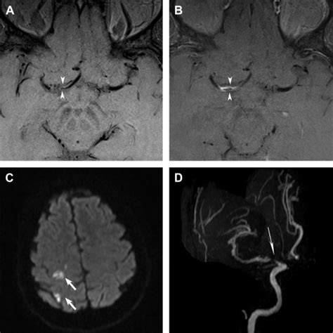 High Resolution Magnetic Resonance Vessel Wall Imaging In Intracranial