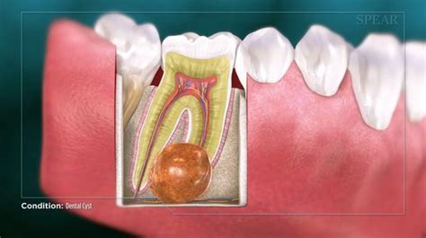 Cyst Removal Tooth In Gandhinagar Laxminarayan Multispeciality Dental