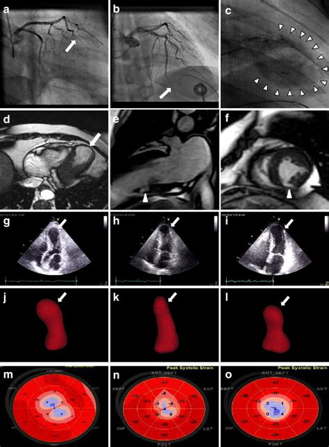 Recurrent Tako Tsubo Syndrome Tts In A Woman With Coronary Artery