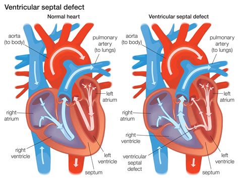 What Are Ventricular Septal Defects