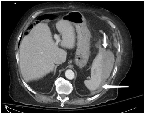 Atraumatic Splenic Rupture In A Patient On Apixaban And Dual