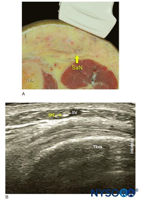 Ultrasound Guided Saphenous Adductor Canal Nerve Block Nysora
