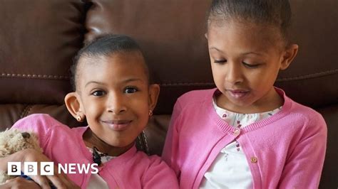 Conjoined Twins Sisters Meet Surgeons Who Separated Them
